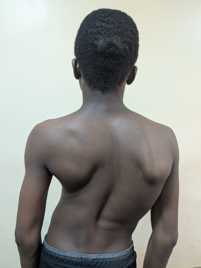 Before: Adolescent Idiopathic Scoliosis